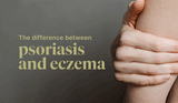 Ten Ways to Tell Psoriasis and Eczema Apart